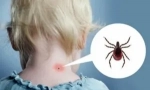 Reakcia tela a tick bite space