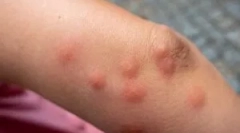 Alergia na uhryznutie claop