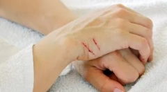 Choroby prenášané cez uhryznutie a škrabance