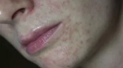 Demodecóza: čo to je, príznaky a liečba