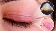 Demodekóza: príčiny, príznaky a liečba