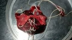 Červy v pečeňových tkanivách