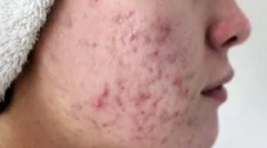 Ako sa demodikóza prenáša?