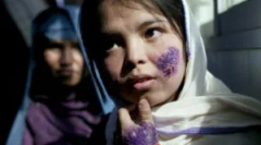 Ako sa infikovať leishmeni: symptómy a liečba leishmaniózy