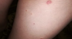 Prečo niektorí ľudia uhryznú blchy, a neexistujú žiadne iné