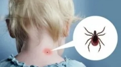 Reakcia tela a tick bite space