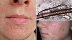 Analýza dodania demodekózy