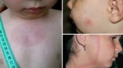 Symptómy a liečba borreliózy u dieťaťa