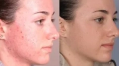 Prostriedky na liečbu demodikózy