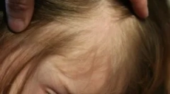 Vši a šortky v jej vlasoch v dieťaťu